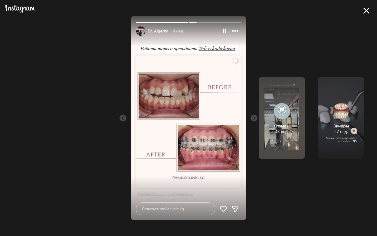 Брекет-системы — результат до и после лечения