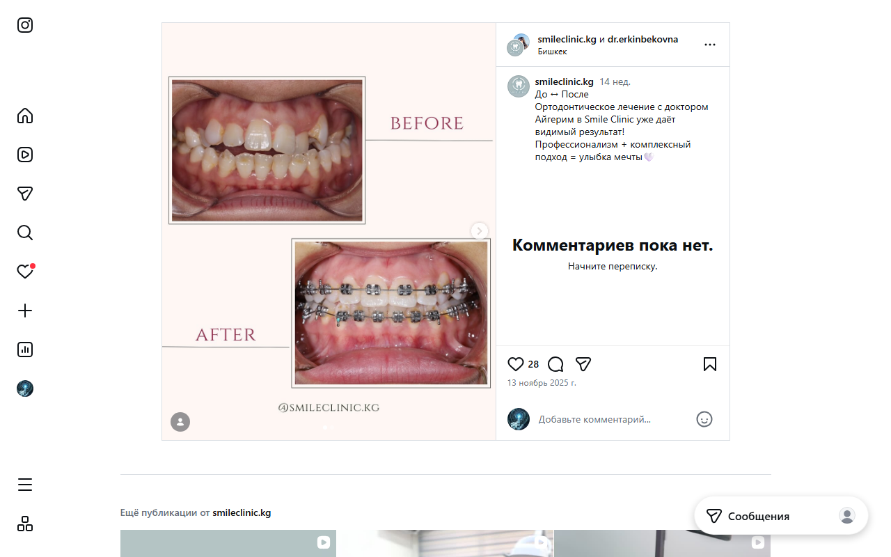 Ортодонтия — финальный результат