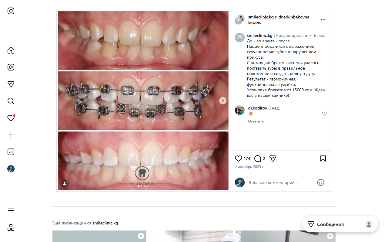 До и после установки брекетов — Smile Clinic